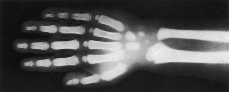X-Ray Hand